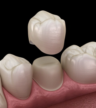 Dental Crowns