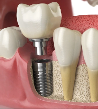 implant crowns