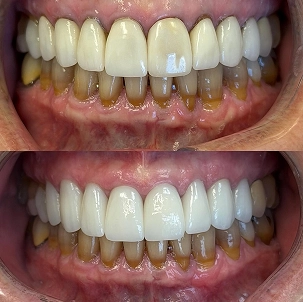 Teeth Cleaning in Boca Raton